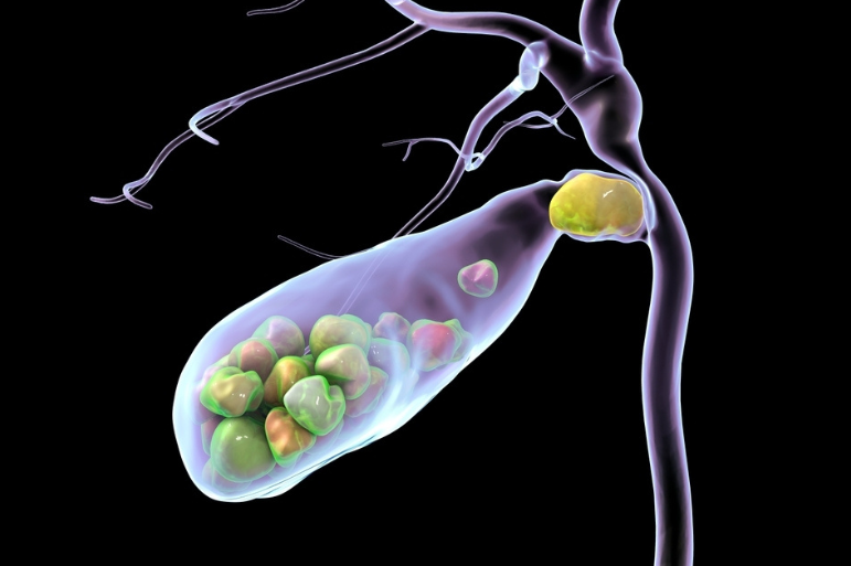 Πέτρες στη χολή